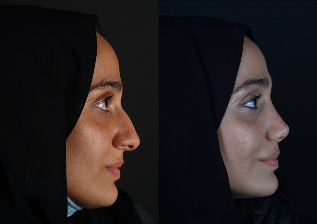 näsoperation före och efter