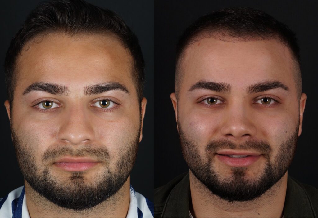 مقارنة قبل وبعد لرجل شاب بشعر داكن قصير ولحية تُظهر تحسن المظهر الوجهي، على الأرجح بعد علاج تجميلي، مع بشرة أكثر نعومة وخط شعر أكثر كثافة وتماثل أفضل على خلفية داكنة