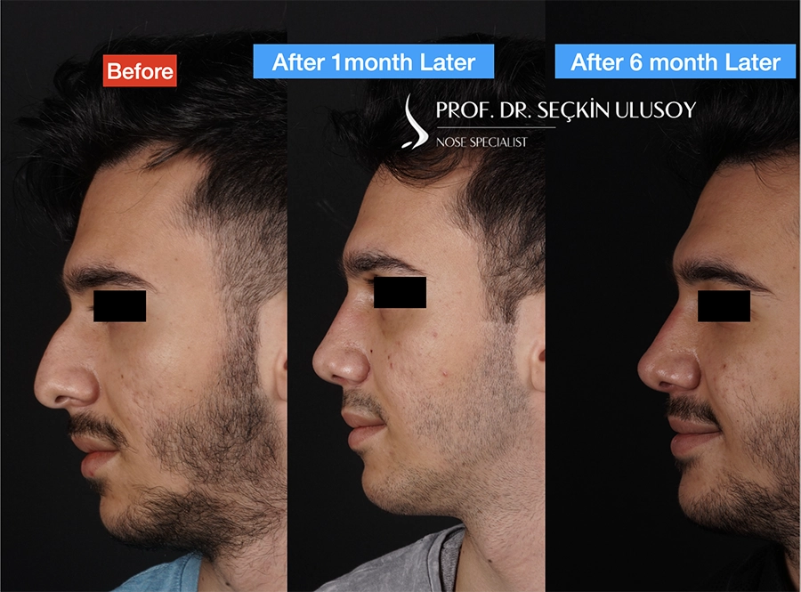 نتائج قبل وبعد عملية تجميل الأنف للرجال تُظهر تحسن المظهر الجانبي بعد شهر واحد و6 أشهر من الجراحة