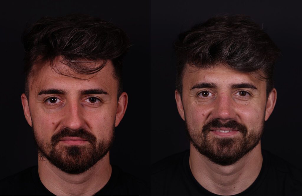 صورة قبل وبعد لرجل تُظهر تحولًا في ملامح الوجه مع تحسن لون البشرة ولحية أكثر كثافة ومظهر أكثر انتعاشًا على خلفية داكنة