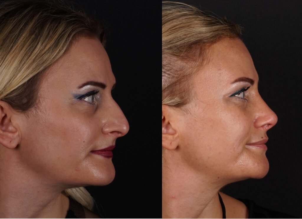 صورة جانبية قبل وبعد لعملية تجميل الأنف لامرأة تُظهر تحسن شكل الأنف ورفع طرف الأنف وتحسين التناسق الوجهي، نتائج جراحة تجميل الأنف