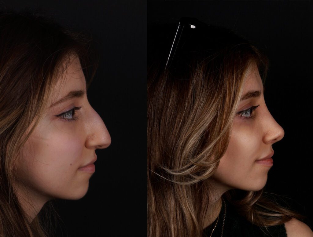 صورة جانبية قبل وبعد لعملية تجميل الأنف لامرأة شابة تُظهر تحسن شكل الأنف والتناسق الوجهي على خلفية سوداء