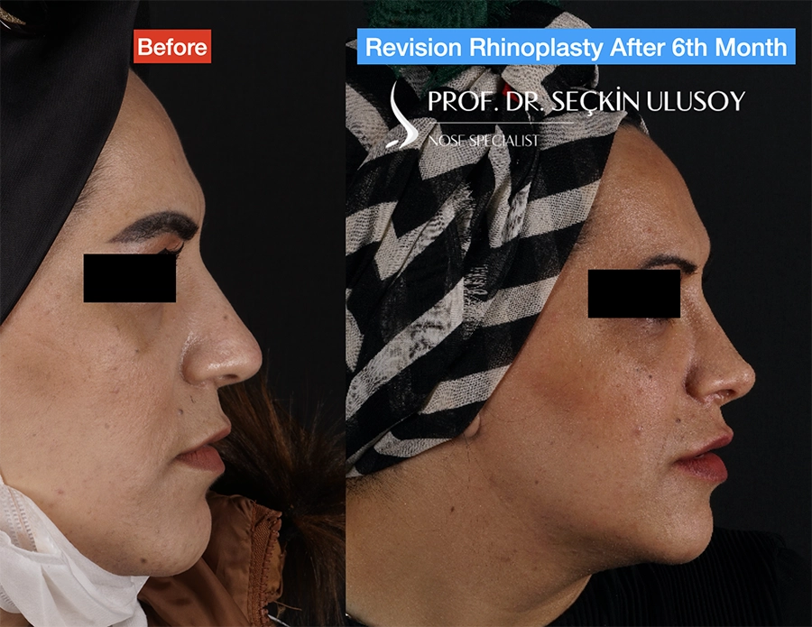 صورة جانبية قبل وبعد لمريضة تُظهر نتائج عملية تجميل أنف تصحيحية بعد 6 أشهر مع تحسين شكل الأنف وجسر الأنف وتعزيز التناسق الوجهي